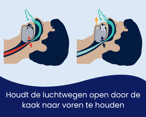 Snoreeze Oral Device gouttière anti-ronflement buccale réglable